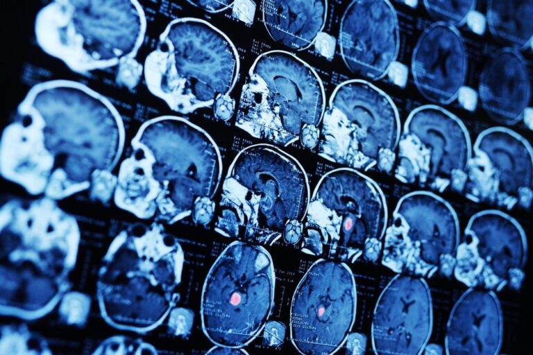 La dépression laisse une marque durable sur le cerveau, même en l’absence de symptômes